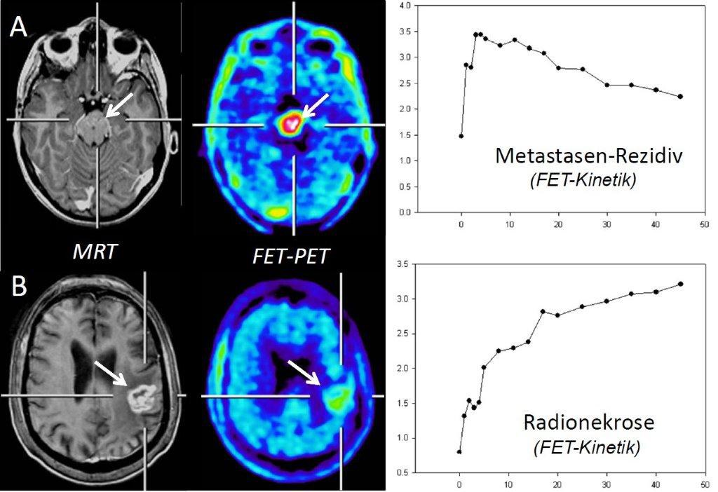 Metastasenwachstum - Abbildungen von MRT und FET-PET-Messungen