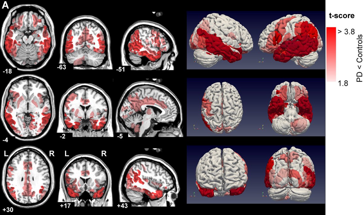 Parkinson-Puzzleteil gefunden