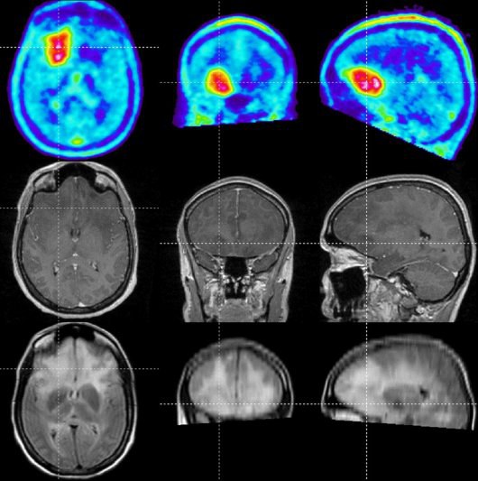 Hirntumor-MRT-FET-PET2_klein_jpg