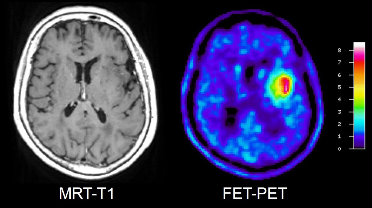 Hirntumor mit MRT und FET-PET