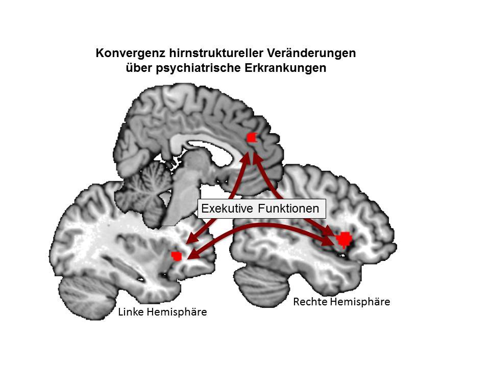 Konvergente Volumenreduktionen der grauen Substanz bei verschiedenen psychiatrischen Erkrankungen in drei Regionen des Gehirns