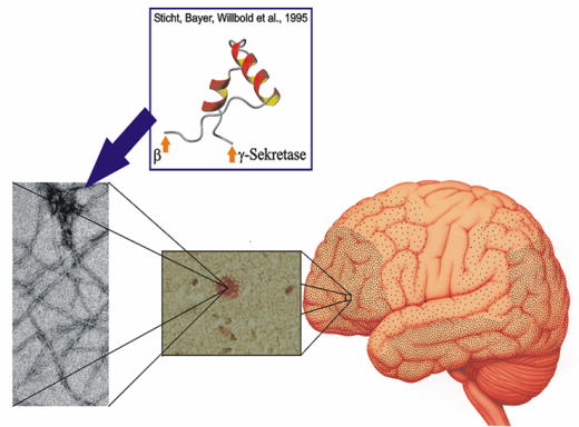 Alzheimersche Demenz