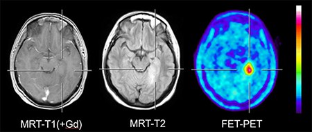 Radiotracer für Hirntumordiagnostik freigegeben