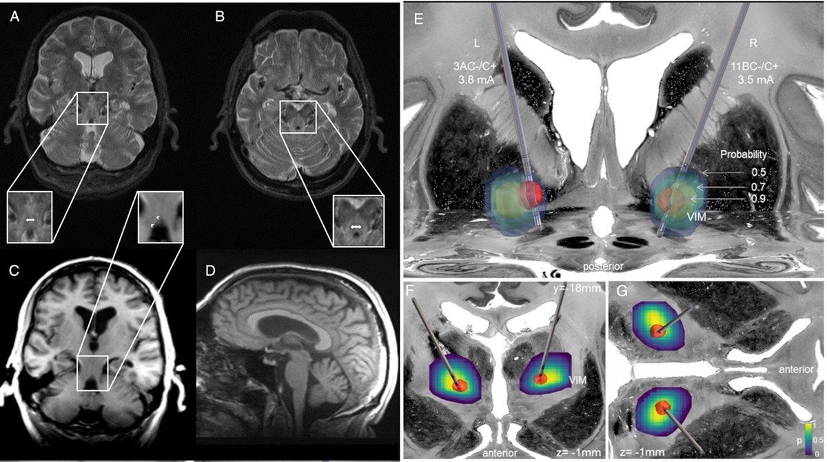 Tiefe Hirnstimulation ist wirksam bei seltener motorischer Krankheit