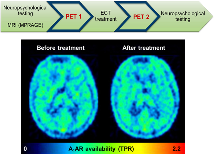 Einfluss von Elektrokonversionstherapie auf den Adenosin A1 Rezeptor bei depressiven Patienten
