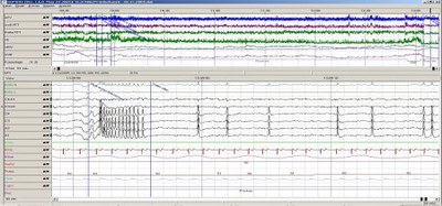 Elektroenzephalographie (EEG)