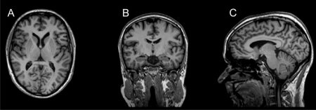 Magnetresonanz-Tomographie (MRT)
