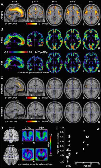 Serotonin-5-HT2A-Rezeptorveränderungen bei Progressiver Supranukleärer Paralyse