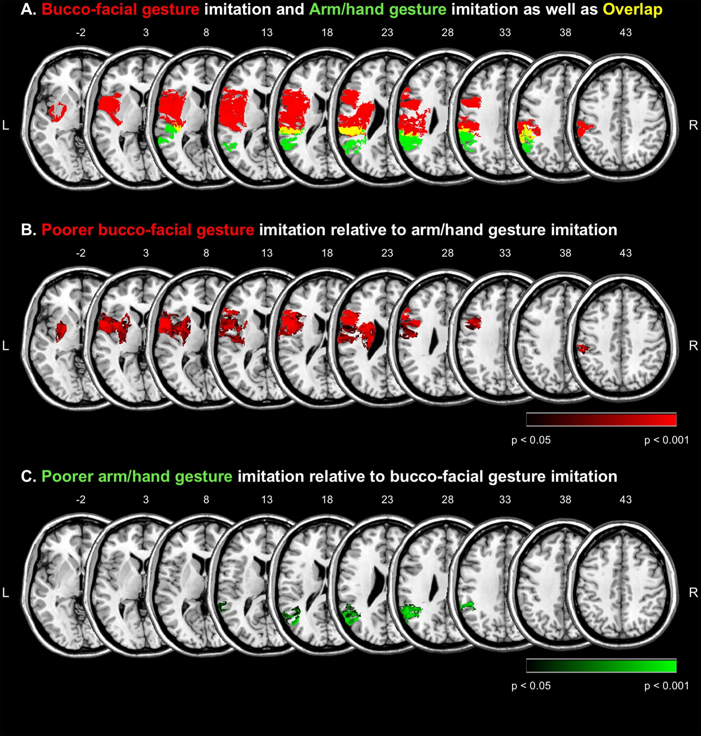 Gesture meaning modulates the neural correlates of effector-specific imitation deficits in left hemisphere stroke