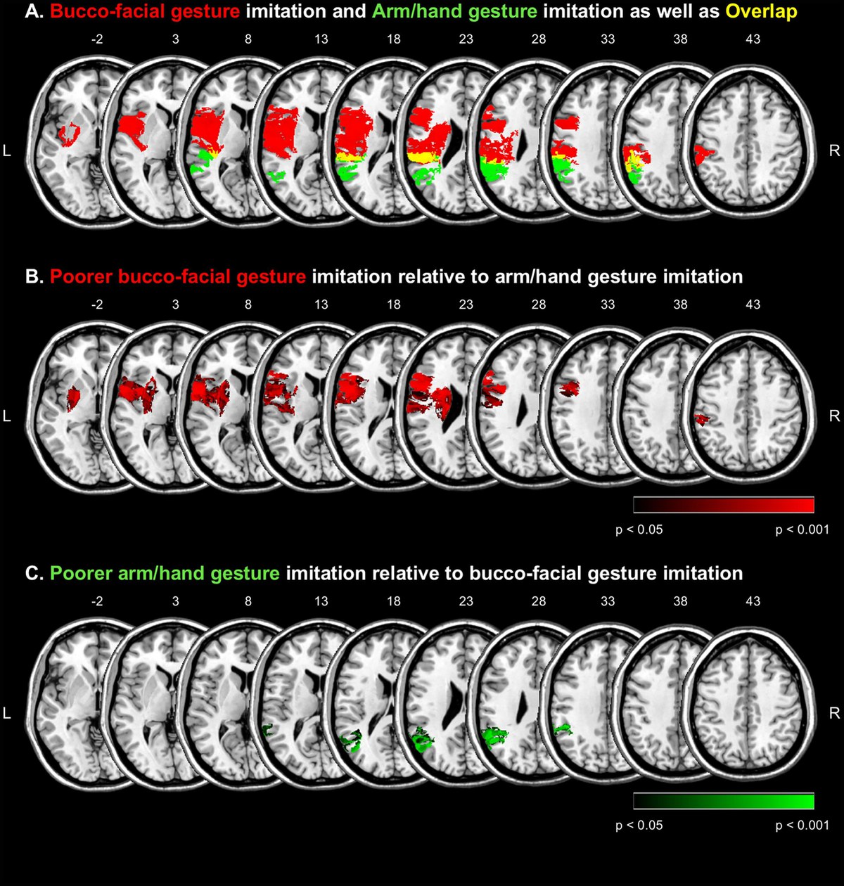 Gesture meaning modulates the neural correlates of effector-specific imitation deficits in left hemisphere stroke