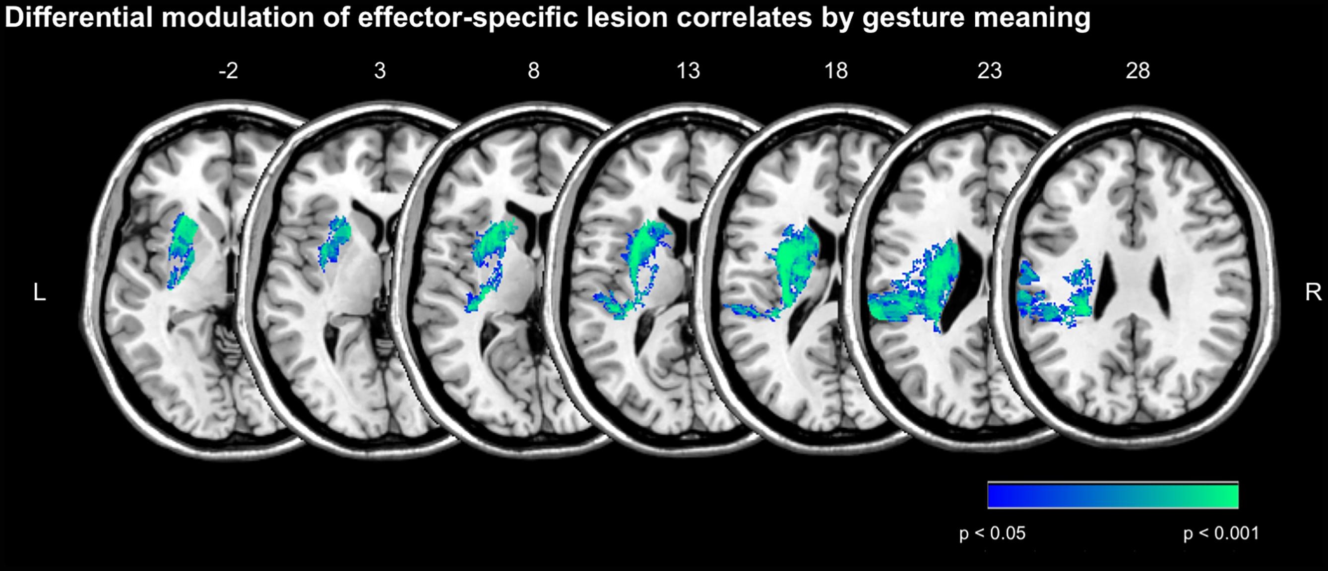 Gesture meaning modulates the neural correlates of effector-specific imitation deficits in left hemisphere stroke