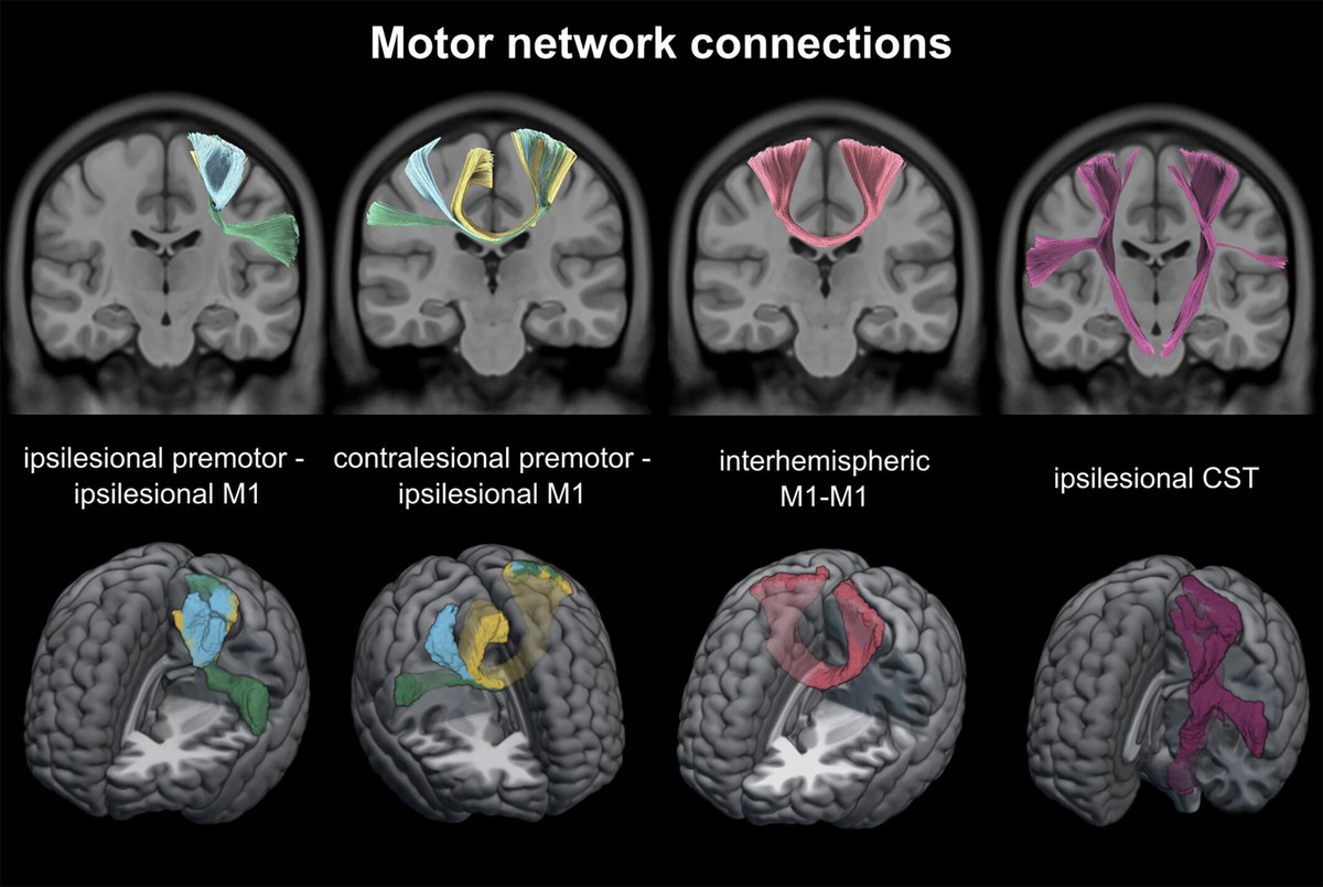 Interhemispheric structural connectivity underlies motor recovery after stroke