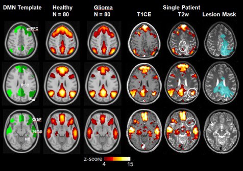 Role of the default mode resting-state network for cognitive functioning in malignant glioma patients following multimodal treatment