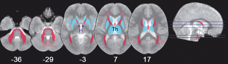 Brain structures affected by increased free water content in obesity