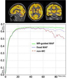 Comparison of the motion correction results between the MR‐guided MAF, fixed‐MAF and for the images without motion correction, for a dynamic PET reconstruction for one test subject.
