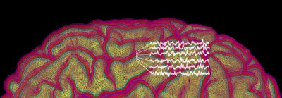 2022 Laminar MRI.jpg