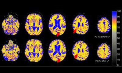 Quantitative Bestimmung der Änderung des Wassergehalts nach Liquorentfernung bei idiopatischem Normaldruck Hydrocephalus