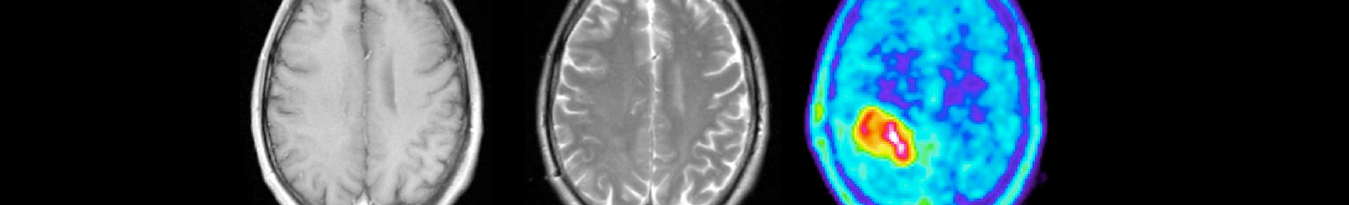 NUKLEARMEDIZINISCHE HIRNTUMORDIAGNOSTIK