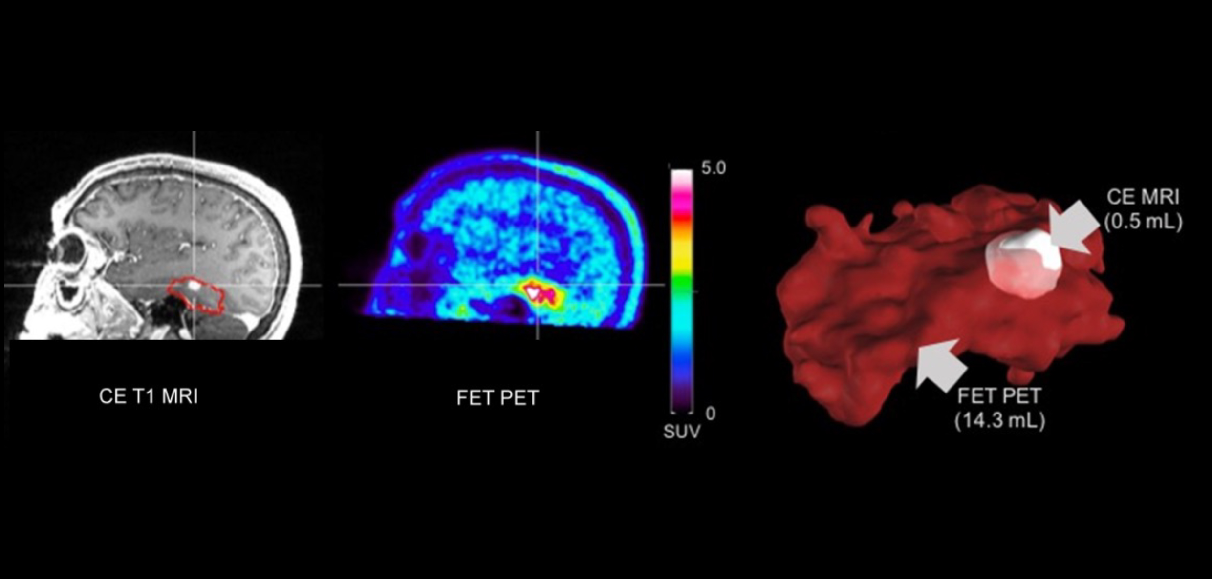 NUKLEARMEDIZINISCHE HIRNTUMORDIAGNOSTIK