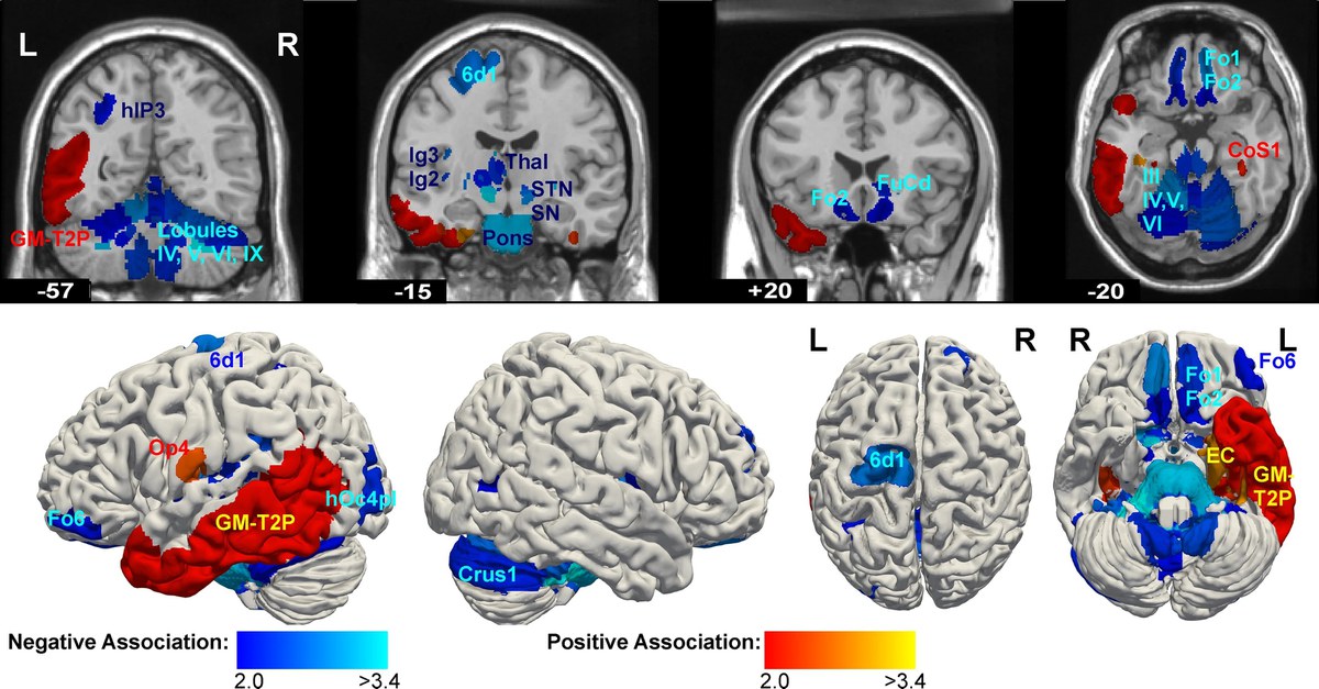 New study identifies brain networks underlying psychopathy