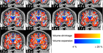 New study reveals how the volumes of brain regions change in Parkinson’s disease