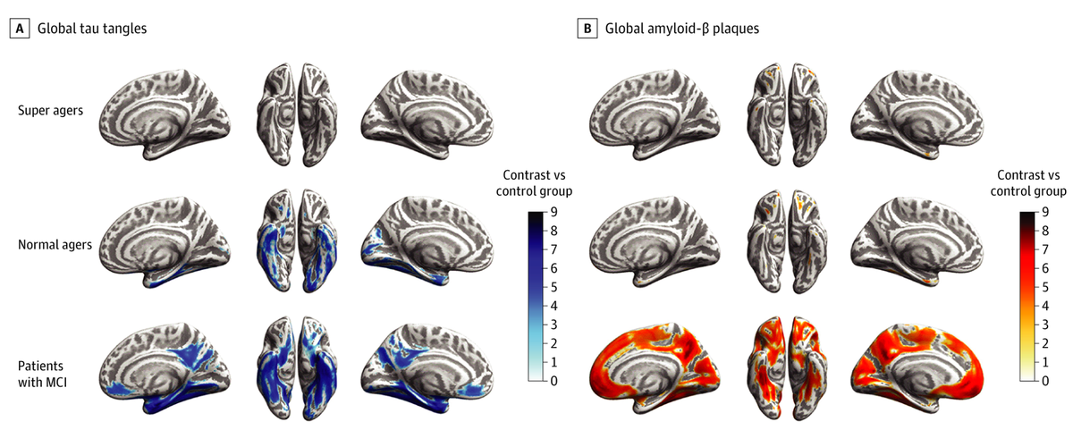 Neurodegeneration