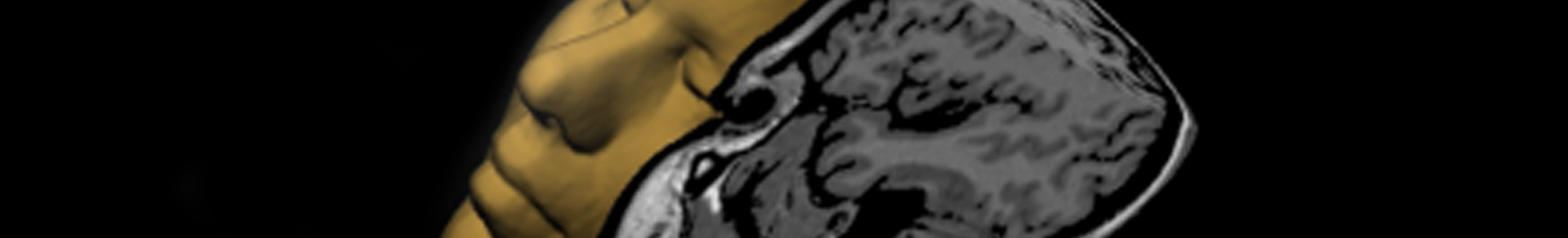 MRI