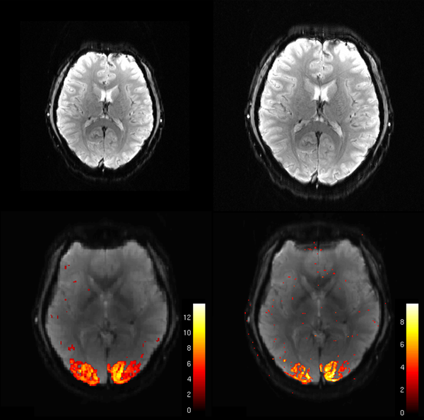 EPIK & High-resolution fMRI
