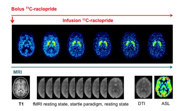 A genetic simultaneous MR-PET-EEG/EMG study on the effects of nicotine on early attention processing in smokers and non-smokers
