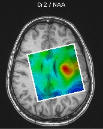 MRI Spectroscopy