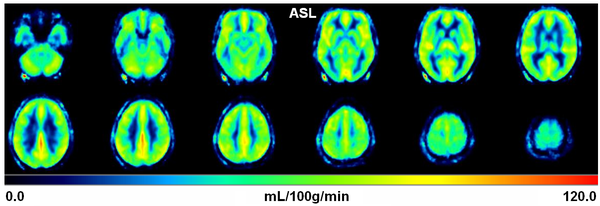 Arterial Spin Labeling