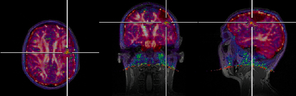 Trimodal Imaging in one Session: FET-PET, MP-RAGE and DTI in Humans