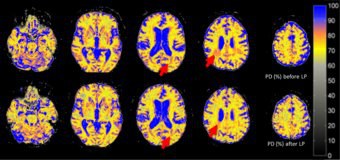 Quantitative cerebral water content changes after CSF removal in idiopathic normal pressure hydrocephalus