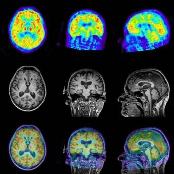 Quantitative PET imaging with MR-PET