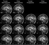 Multichannel compressive sensing reconstruction on the prospectively and retrospectively sampled Fourier-encoded and chirp-encoded data from MPRAGE sequence.