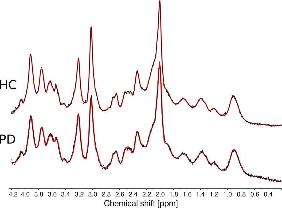 Motor Response to Dopaminergic Therapy in Parkinson"s Disease