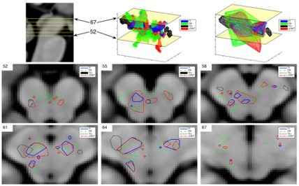 A robust method for the detection of small changes in relaxation parameters and free water content in the vicinity of the substantia nigra in Parkinson’s disease patients